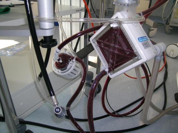Basic Principles of ECMO Support for the failing