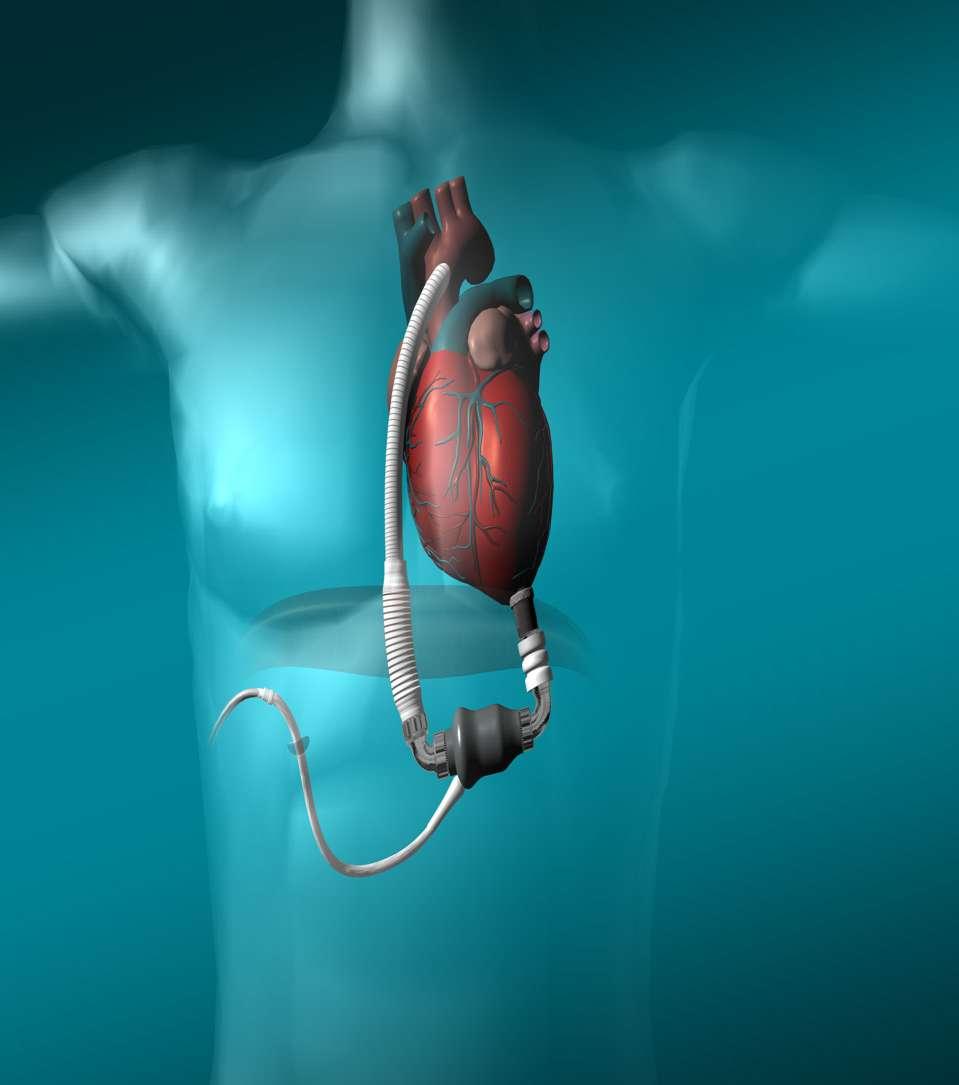 BTT 90% of patients can get by with just an LVAD DT 10-15% of