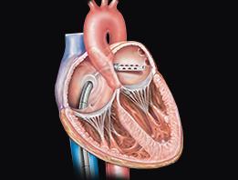 Tandem Heart Left Atrial - Aorta Percutaneous Insertion Centrifugal Pump Control Console Transeptal Cannula Large End Hole 14 Side Holes Arterial