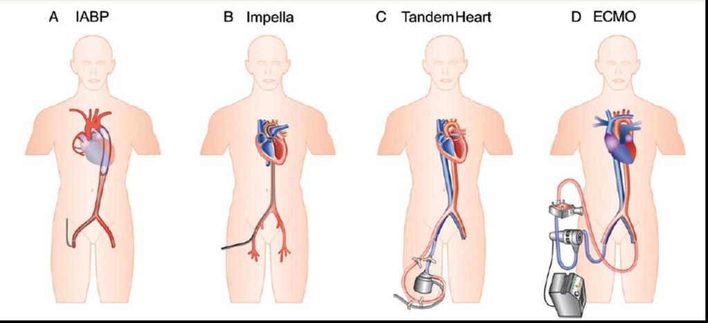 MCS: Percutaneous Ventricular Assist Devices (pvad) Gilotra and