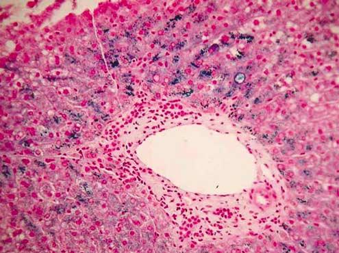 Histopathology of adult hereditary hemochromatosis The hallmark of Types 1 (and 3) HH is the deposition of hemosiderin in hepatocytes and biliary epithelium (Figures 2 4) rather than