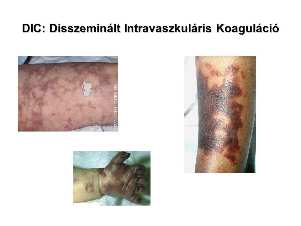 ulceration, gangrene of skin, mucous membranes; oliguria; ARDS) II.