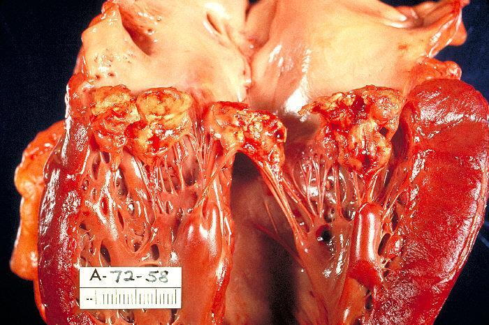 Types of thrombus Arterial thrombi ( white thrombi, mostly platelet aggregation) Venous thrombi (red thrombi, coagulation) Vegetations