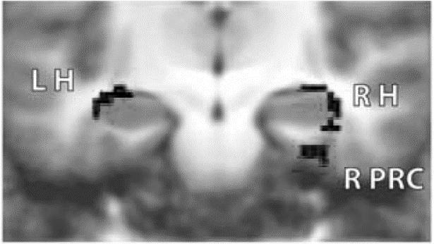 Figure 4.9. Subsequent item memory activity (in black) in the left hippocampus (L H), the right hippocampus (R H), and the right perirhinal cortex (R PRC; coronal view). (Kirwan et al.