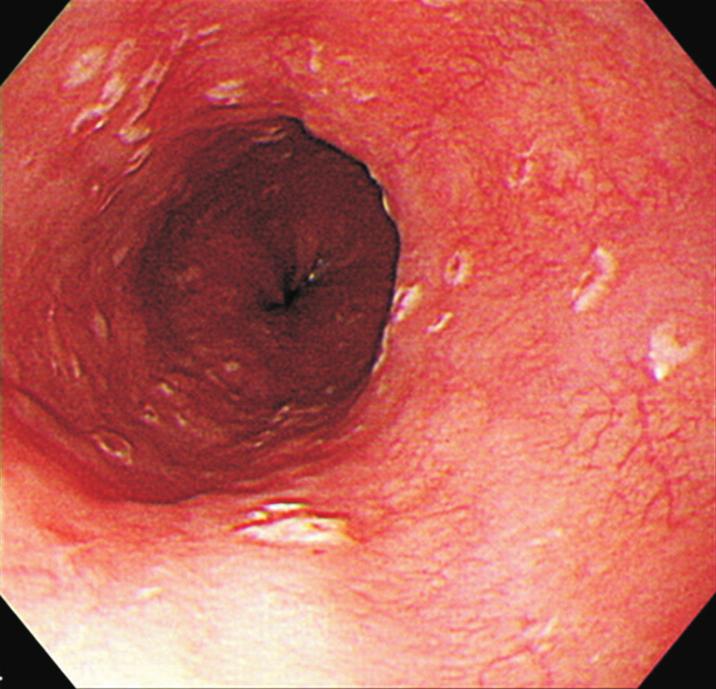 Clinical Features of Eosinophilic Esophagitis tem in Table 2.7 The majority of biopsies were taken from the mid esophagus (19 cases [51.4%]). Nineteen cases (48.