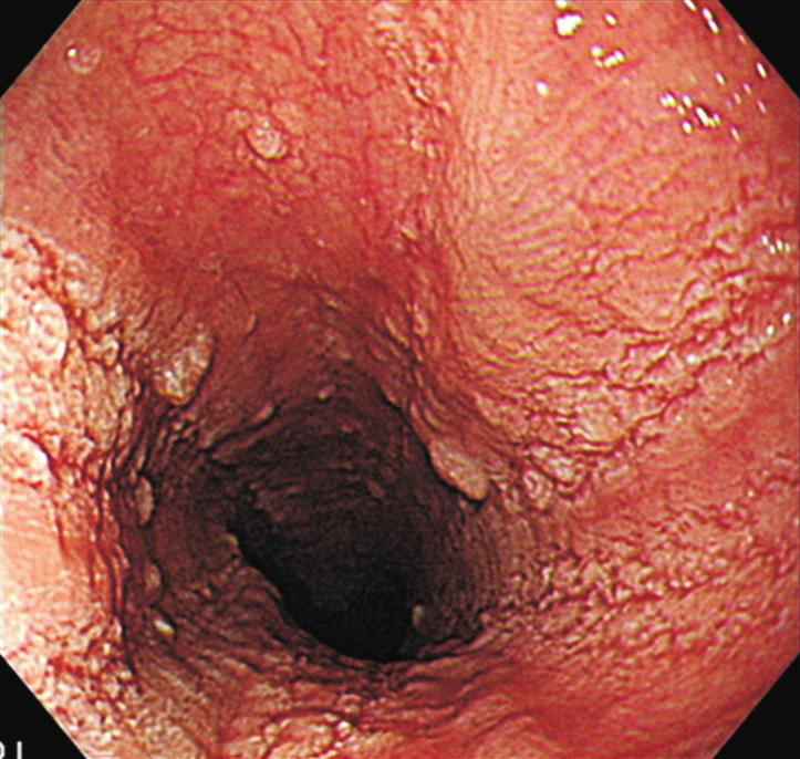 Among a total of 37 patients with EoE, 4 patients had no EoE-specific endoscopic findings, while 33 patients had typical endoscopic findings, and all such patients were male.