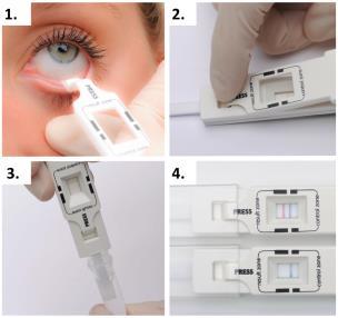 How to Use InflammaDry: Four-step Process 1. Gently dab the Sample Collector in 6-8 locations on the palpebral conjunctiva (lower eyelid) to collect a tear sample. Do not use a dragging motion. 2.