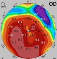 58 yr old female with Keratoconus: Epi-On CXL OD OD Pre Op 12 months Post