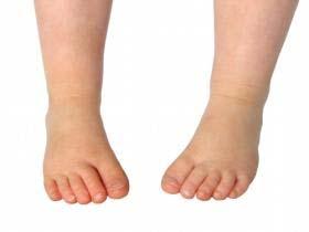 Lower extremity exam Childs gait shows stable, fluid, consistent gait pattern with 5 degrees internal foot progression on left and 10 degrees internal on right In stance and during gait child has a