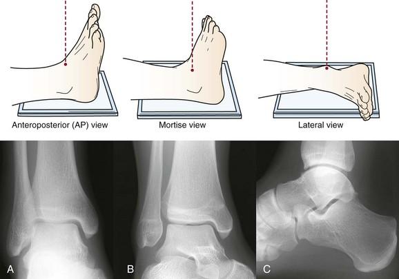 Imaging 3 views of the ankle