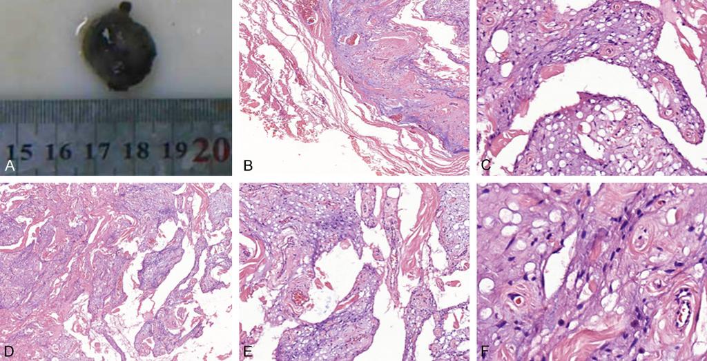 Figure 1. Pathologic findings of a pseudoangiomatous spindle cell lipoma (PASCL). A. Gross appearance of the neck PASCL. The mass was gray-brown oval with clear boundary, measured 2.0 1.5 1.