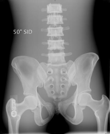 How much more anatomy can be seen on an abdomen when the SID