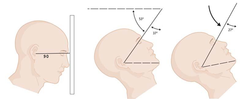 14. Case Study #5: Waters for facial bones: Pt cannot fully raise chin You estimate that the nasomeatal line is horizontal What is the head position? What is the angled CR correction?
