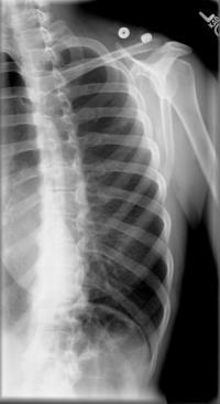 anterior ribs have come across the spine).