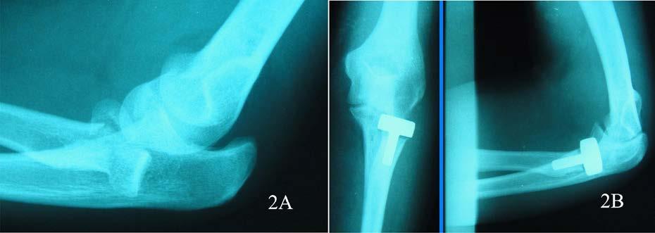 K. Gharanizadeh, et al. 2. A. The comminuted fracture of radial head in terrible triad. B. the radial head arthroplasty. The mean flexion-extension arc of the elbow was 102.63 ± 33.22 (5 to 140 ).