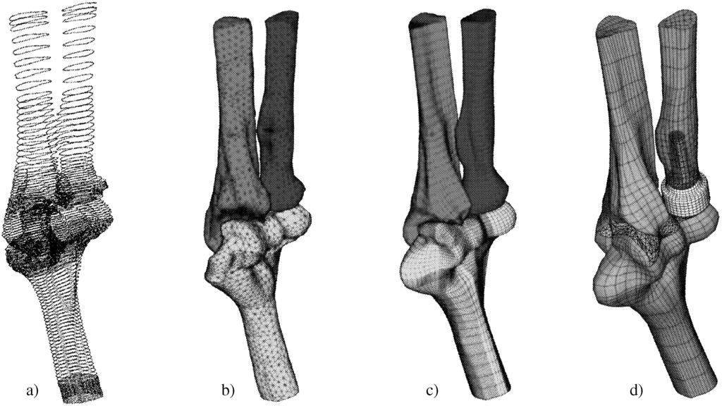 322 Hlavoň P. et al.: Stress Analysis of the Radial Head Replacements in an Elbow Articulation Fig.