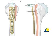 Confirmation of correct plate position The correct plate position can be checked by palpation of its relationship to the bony structures and