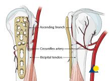 Pitfall 1: plate too close to the bicipital groove The bicipital tendon and the ascending branch of the anterior humeral circumflex artery are