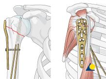 With the plate in proper position, tighten this screw securely. joint. Fix plate to the humeral head Drill holes Use an appropriate sleeve to drill holes for the humeral head screws.