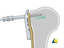 when the screws are initially placed. Secondary penetration is the result of subsequent fracture collapse. Drilling into the joint increases the risk of screws becoming intraarticular.