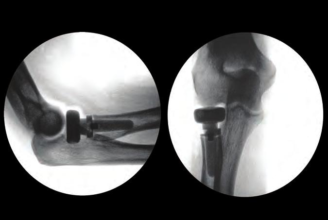 over-stuffed Fluoroscopic imaging should be used to verify the proper fit of the trial