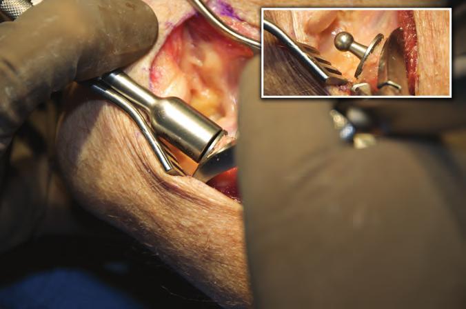 17 PROSTHETIC STEM INSERTION Insert the Radial Stem implant using the Stem Impactor until