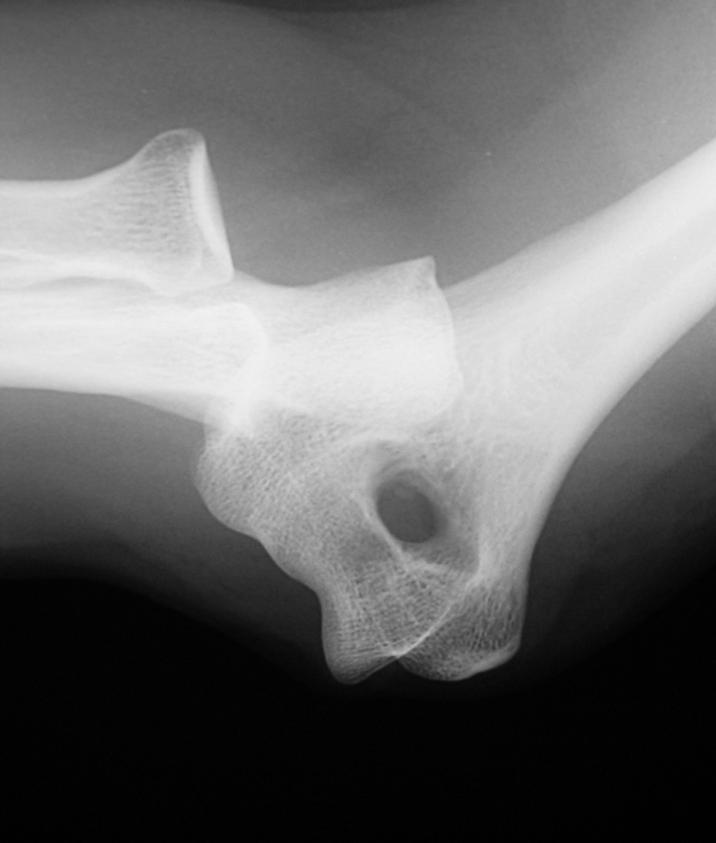Simple Elbow Dislocation No associated fractures Complete or near complete capuloligamentous injury Extensive