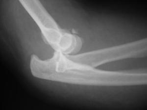 Injuries Dislocation with