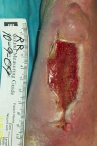 progression of a diabetic foot ulcer with