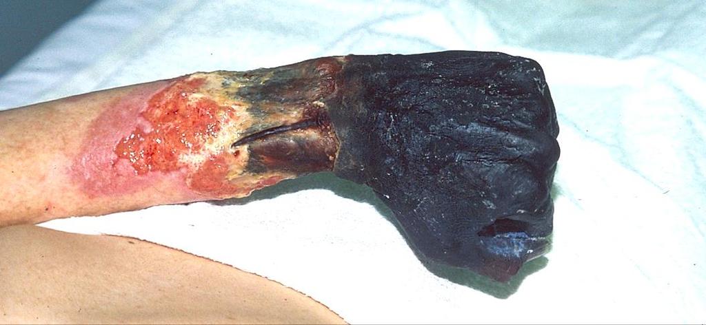 Hand gangrene due