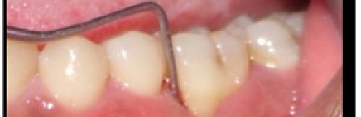 in periodontal defects. Int J Periodontics Restorative Dent 2007; 27:421-427. 7.