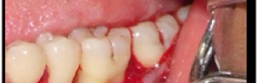 The use of a porous hydroxyapatite implant in periodontal defects I. Clinical results after six months.