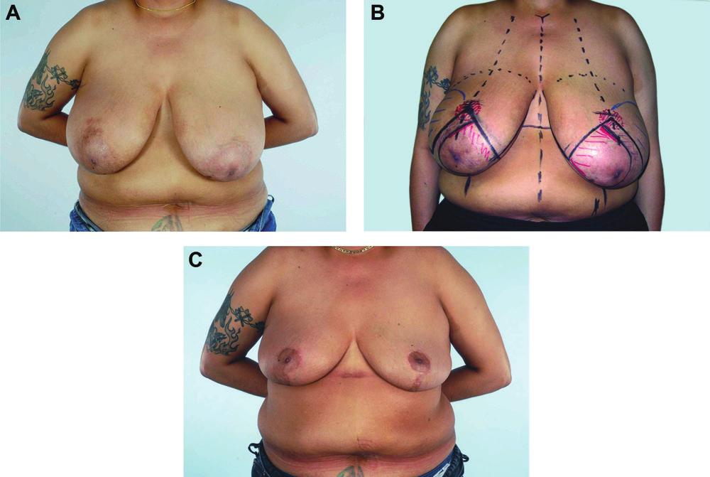 76 Aesthetic Surgery Journal 34(1) Figure 1. (A) This 47-year-old woman presented after previous right breast irradiation.