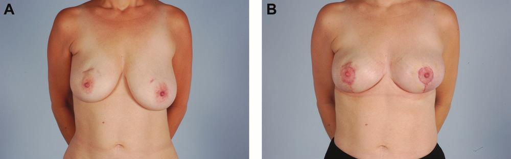 (C) Fourteen months after reduction mammaplasty, in which 816 g was resected from the right breast. Figure 2. (A) This 49-year-old woman presented after previous right breast irradiation.