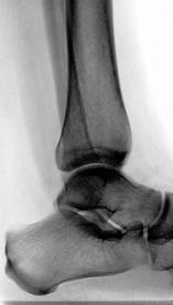 UNSTABLE LATERAL MALLEOLUS ACTS AS BUTTRESS / POST RESIST LATERAL
