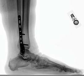 ANKLE/SYNDESMOSIS