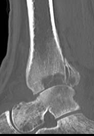 CT SCAN ASSESS JOINT SALVAGEABILITY BILATERAL CT SCAN USEFUL FOR SUBTLE CASES