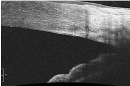 arrow) Cirrus HD-OCT Anterior Segment