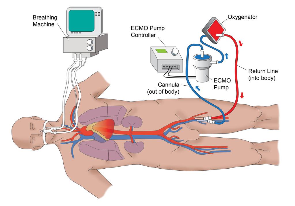 ECMO 3 Extracorporeal Membrane Oxygenation ECMO is a life support treatment for people with severe respiratory (lung) failure or heart failure that does not respond to usual treatments.