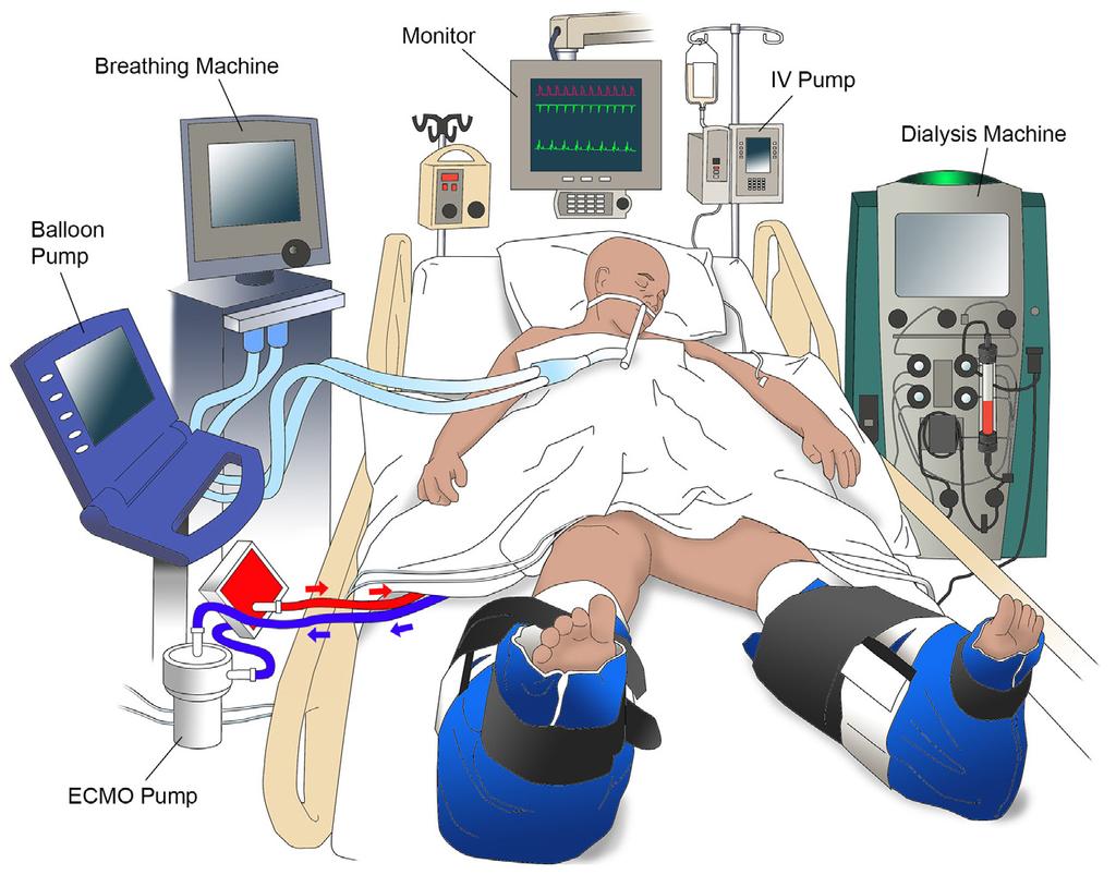 ECMO Treatment What to expect 5 It can be overwhelming to walk into a room to see your loved one on this treatment. He or she will be connected to many tubes and machines.