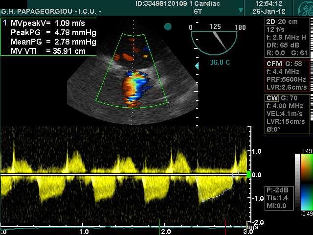 Mitral stenosis Very unusual in