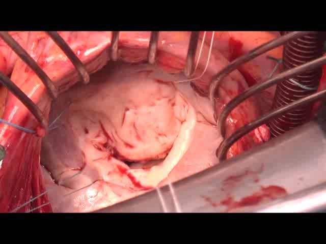 Commissurotomy Case1 Debulking of anterior leaflet (with resection of fibrous