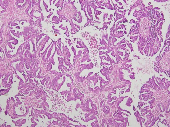 ARSHAD M. AND NIAZI S. Fig. 1: Photomicrograph of a high grade papillary serous cystadenocarcinoma (H&E X 100). Fig. 3: Photomicrograph of a mucinous cystadenocarcinoma showing glands filled with mucin pools (H&E, 100X).
