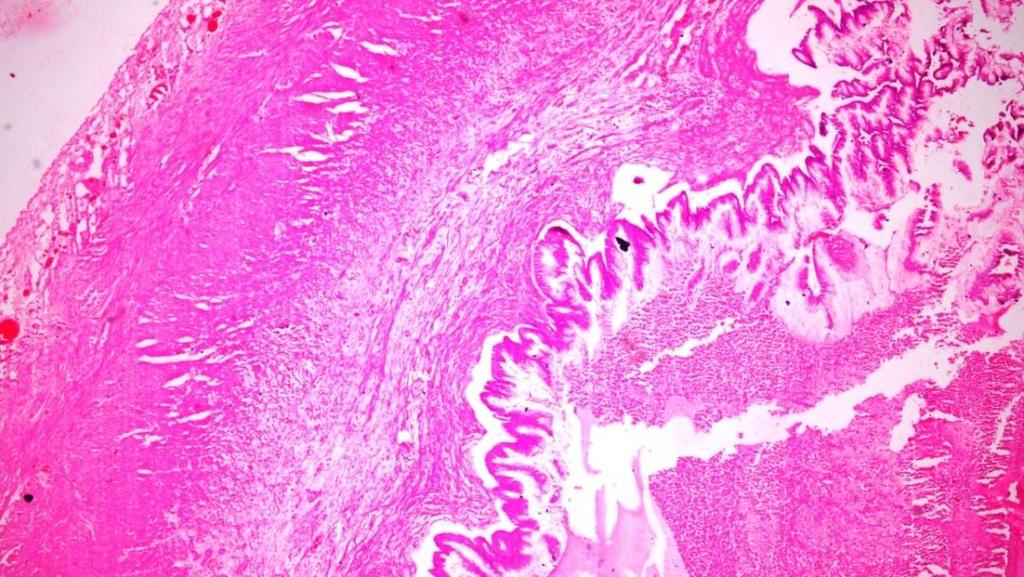 Figure II: Microphotograph of Mucinous cystadenoma of the ovary