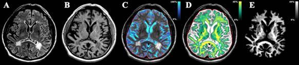 Quantification objective decision support SyMRI brings the clinician flexible imaging and quantitative tissue assessment for neurodegenerative diseases, all based on one single MRI scan.