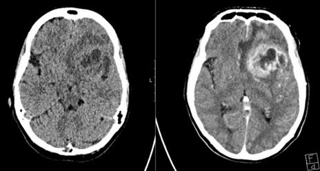Example on malignant glioma Case from a Swedish university hospital where synthetic MRI has been evaluated on tumor patients.
