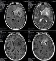 12 CT images of the patient at first visit, left pre-contrast, right post-contrast Fig. 12 Set-up for the MR examination.
