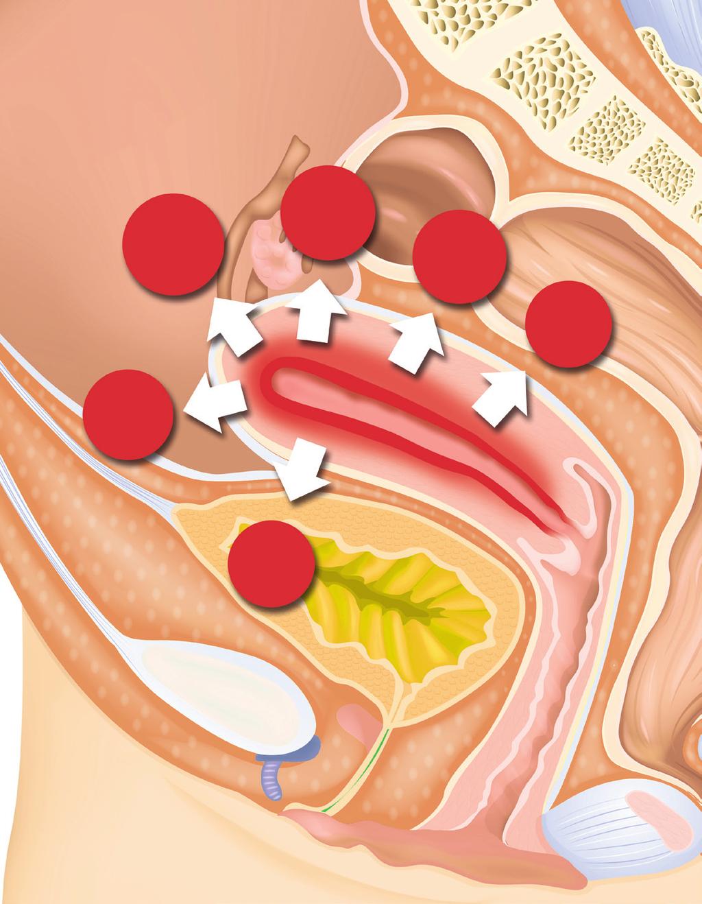 ENDOMETRIOSIS Depth and location Uterine wall Fallopian tubes Bladder Ovaries Peritoneum Colon Peritoneum Ovaries Fallopian tubes Uterine wall