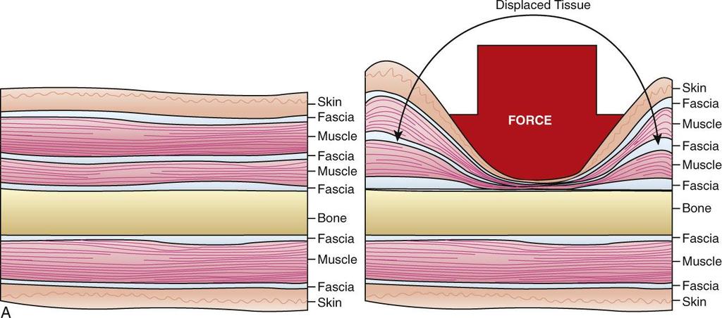 Depth of Pressure Massage applications systematically generate force through each tissue layer.