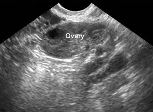 Pitfalls: ultrasound alone is not enough Normal ovary Polycystic ovary